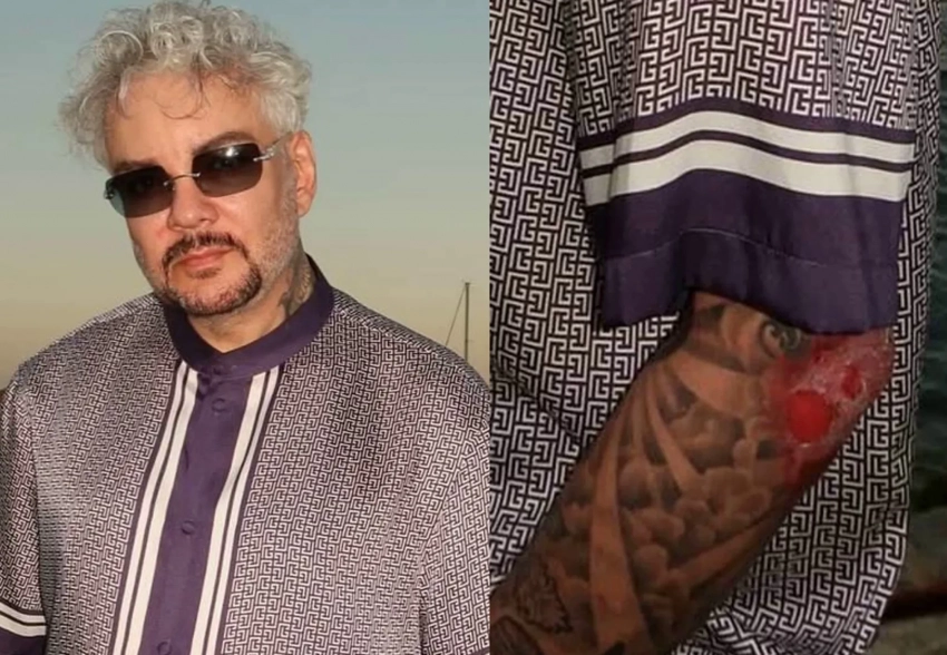 "Молодильные яблоки от Тимура Хайдарова не сработали". В сети обсуждают новые фото Филиппа Киркорова, который впервые показал ожог после инцидента с пиротехникой